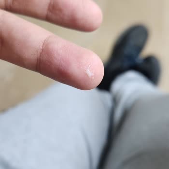 Sensodyne Extra Beyazlatıcı Diş Macunu Kullanımında Ağızda Sümüksü Soyulma Ve Alerjik Endişe