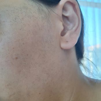 Merve Öztürk Güzellik Salonu Lazer Epilasyon Sonrası Kıllarda Artış Ve Sertleşme