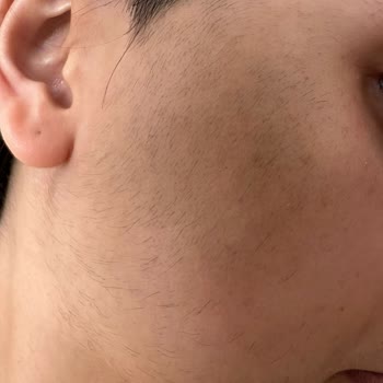 Merve Öztürk Güzellik Salonu Lazer Epilasyon Sonrası Kıllarda Artış Ve Sertleşme