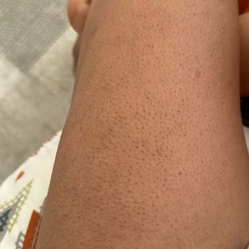 Merve Öztürk Güzellik Salonu Lazer Epilasyon Sonrası Kıllarda Artış Ve Sertleşme