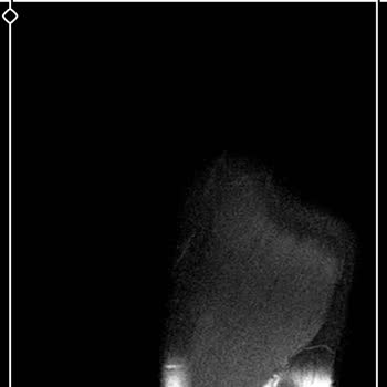 Sultanbeyli Devlet Hastanesi'nde Ortopedi Bölümünün İlgisizliği