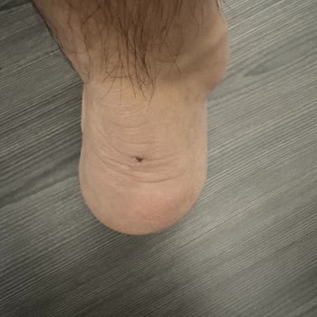 Dexter Maçon Ayakkabısının Hızlı Genişlemesi Ve Yara Oluşması Nedeniyle İade Talebi