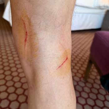 Sheraton Hotels Küvette Kaydırmaz Bant Olması Gerekirken Sökülmüş Olduğunu Gördüm