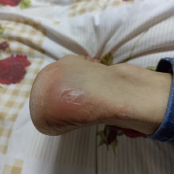 Topuklarda Su Toplanması Ve Yara Açan Bot İçin İade Talebi