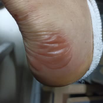 Topuklarda Su Toplanması Ve Yara Açan Bot İçin İade Talebi