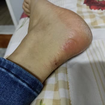 Topuklarda Su Toplanması Ve Yara Açan Bot İçin İade Talebi