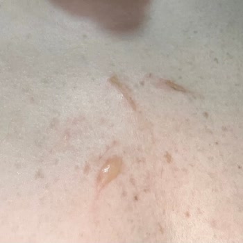 Intimissimi Çift Taraflı Bant Cilt Tahrişi ve Yanıltıcı Bilgilendirme