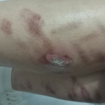 Bu Saloon 100. Yıl Epilasyon Sonrası Yanık Ve Sorumluluk Reddi