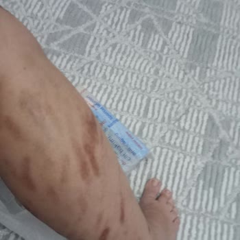 Bu Saloon 100. Yıl Epilasyon Sonrası Yanık Ve Sorumluluk Reddi