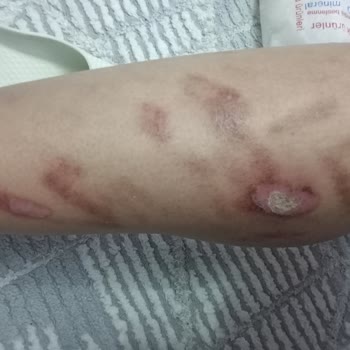 Bu Saloon 100. Yıl Epilasyon Sonrası Yanık Ve Sorumluluk Reddi