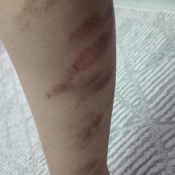 Bu Saloon 100. Yıl Epilasyon Sonrası Yanık Ve Sorumluluk Reddi