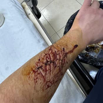 İskenderun Devlet Hastanesi Acil Serviste Hatalı Zımba Uygulamasıyla Kol Kesiklerinde İz Bırakılması