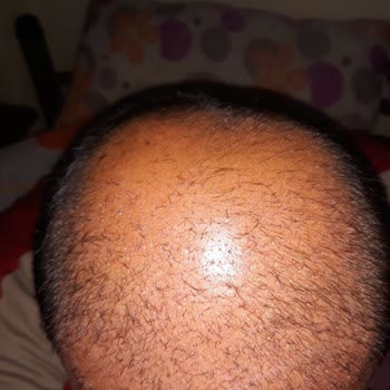 Garanti Verilen Saç Ekimi Sonrası İhmal Ve Yarım Kalan Sonuç
