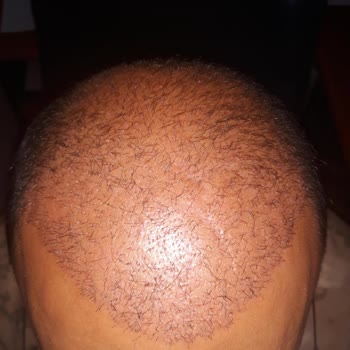 Garanti Verilen Saç Ekimi Sonrası İhmal Ve Yarım Kalan Sonuç