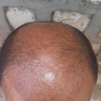 Garanti Verilen Saç Ekimi Sonrası İhmal Ve Yarım Kalan Sonuç