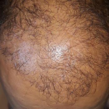 Garanti Verilen Saç Ekimi Sonrası İhmal Ve Yarım Kalan Sonuç