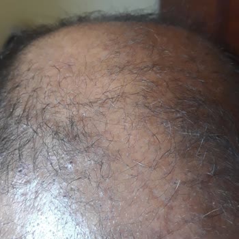 Garanti Verilen Saç Ekimi Sonrası İhmal Ve Yarım Kalan Sonuç