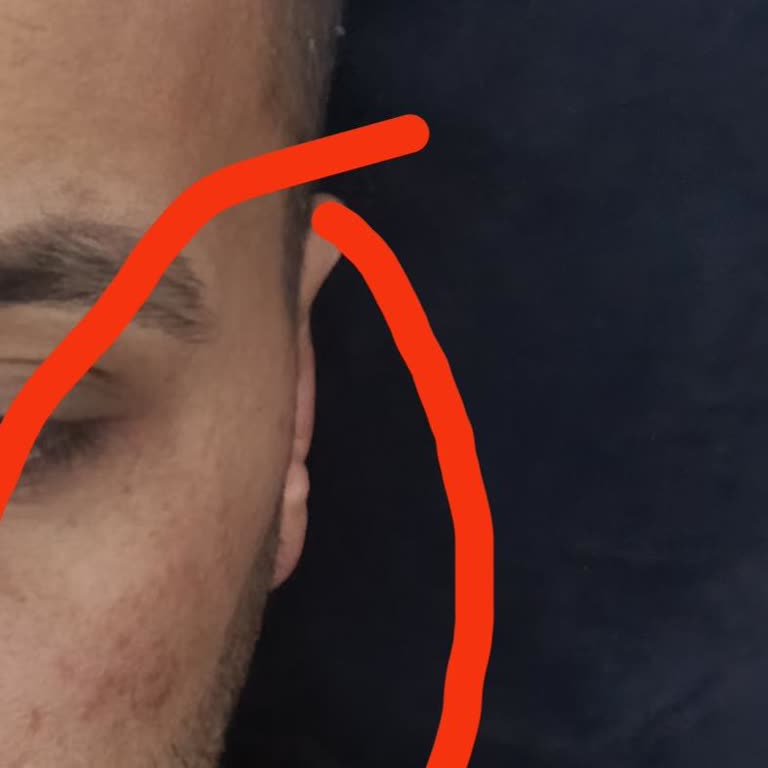 İğneli Leke Tedavisinde Kalıcı İzler Ve Cevapsız Şikayet