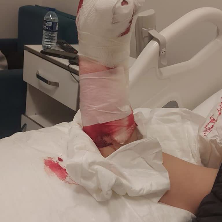 İzzet Baysal Araştırma Hastanesi Yanlış Ameliyat Ve Tedavi Nedeniyle Şiddetli Ağrı Ve İşlev Kaybı