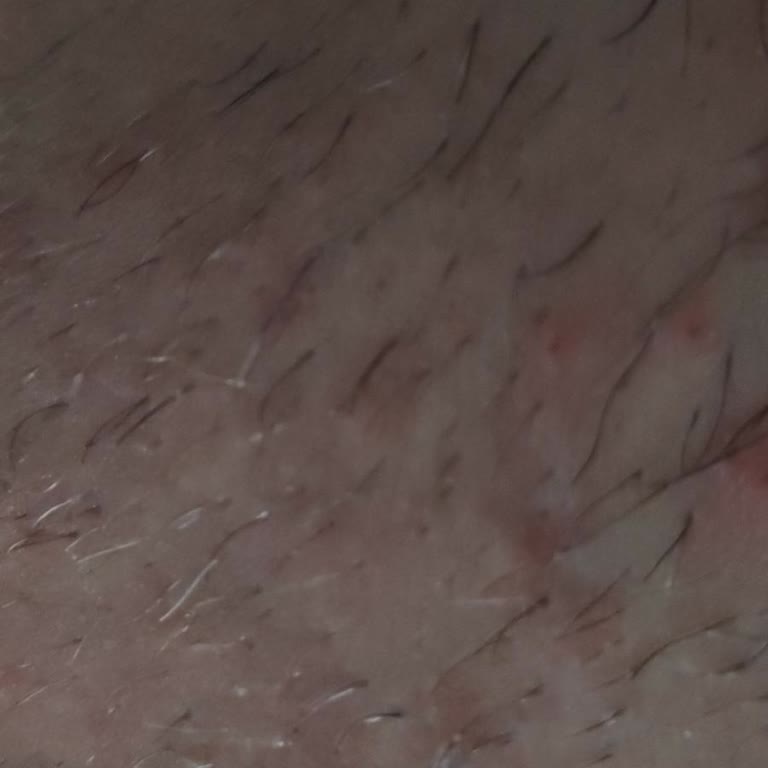 Hassas Ciltler İçin Bitkisel Tüy Dökücü Sprey Şiddetli Yanma Ve Kanama Yarattı