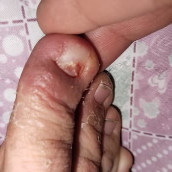 Kısa Sürede Şiddetli Ayak Mantarına Yol Açan Ayakkabı Ve İade Talebi