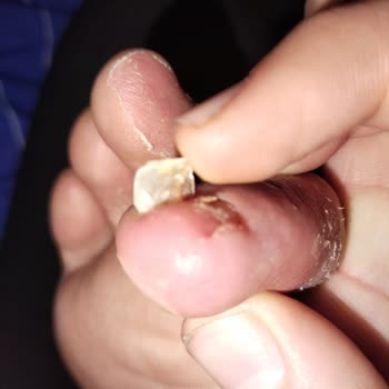 Kısa Sürede Şiddetli Ayak Mantarına Yol Açan Ayakkabı Ve İade Talebi