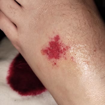 Kısa Sürede Şiddetli Ayak Mantarına Yol Açan Ayakkabı Ve İade Talebi