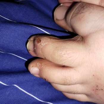 Kısa Sürede Şiddetli Ayak Mantarına Yol Açan Ayakkabı Ve İade Talebi