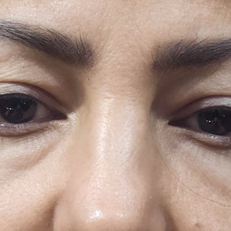 Dermaelite Güzellik Merkezi İzinim Olmadan Yapılan 45.000 TL Ödeme Ve Göz Kapağı Düşüklüğü!