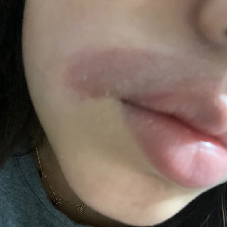 Ağda Bandı Kullanımında Şiddetli Cilt Yanığı Ve Çocuk Mağduriyeti