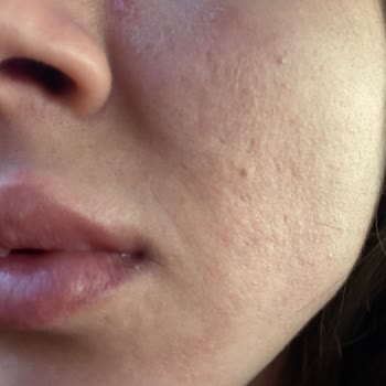 Sephora Cicapair Kremi Cildimde Şiddetli Sivilcelere Ve Tahrişe Neden Oldu