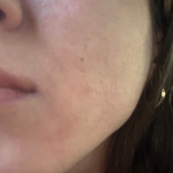 Sephora Cicapair Kremi Cildimde Şiddetli Sivilcelere Ve Tahrişe Neden Oldu