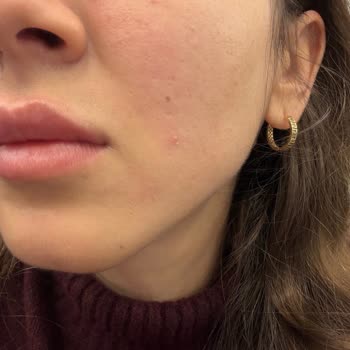 Sephora Cicapair Kremi Cildimde Şiddetli Sivilcelere Ve Tahrişe Neden Oldu