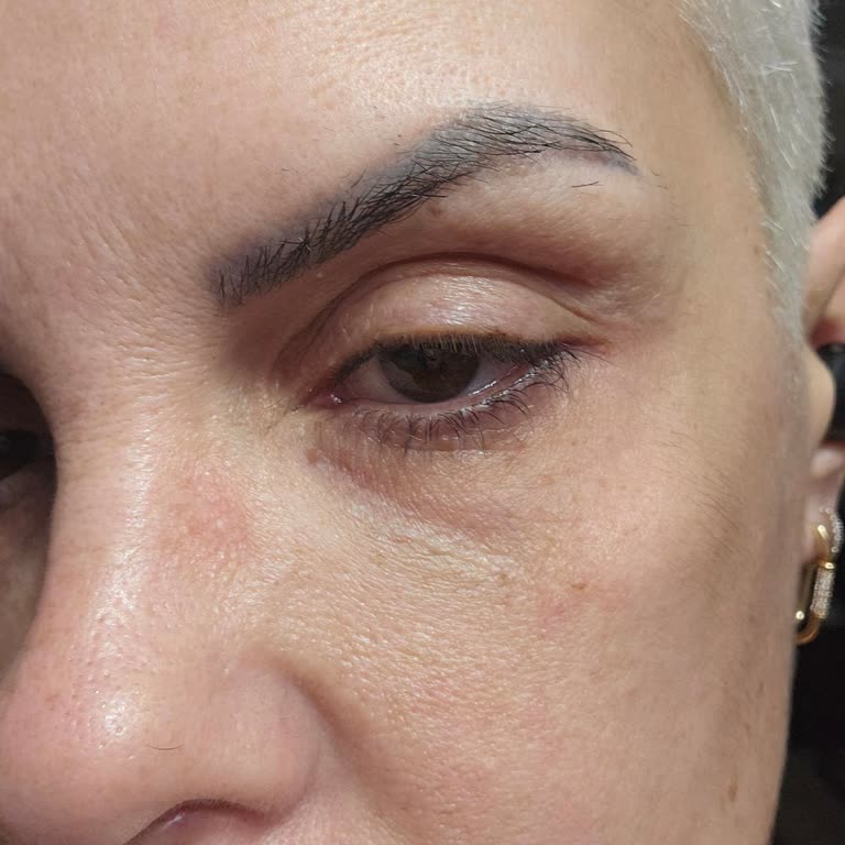 Clinic Allstar İzmir Bayraklı'daki Klinikte Yüz Dolgu İşlemi Sonrası Şişlik ve İade Talebi