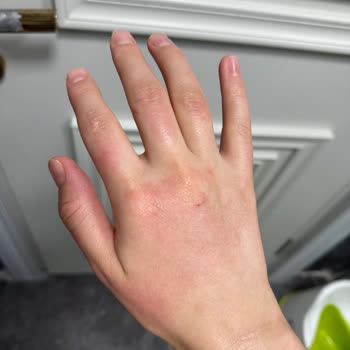 Sleepy Çam Ferahlığı Yüzey Mendili Kullanımında Bebekte Ve Yetişkinlerde Şiddetli Cilt Hassasiyeti