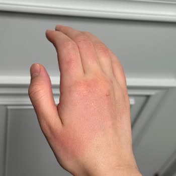 Sleepy Çam Ferahlığı Yüzey Mendili Kullanımında Bebekte Ve Yetişkinlerde Şiddetli Cilt Hassasiyeti