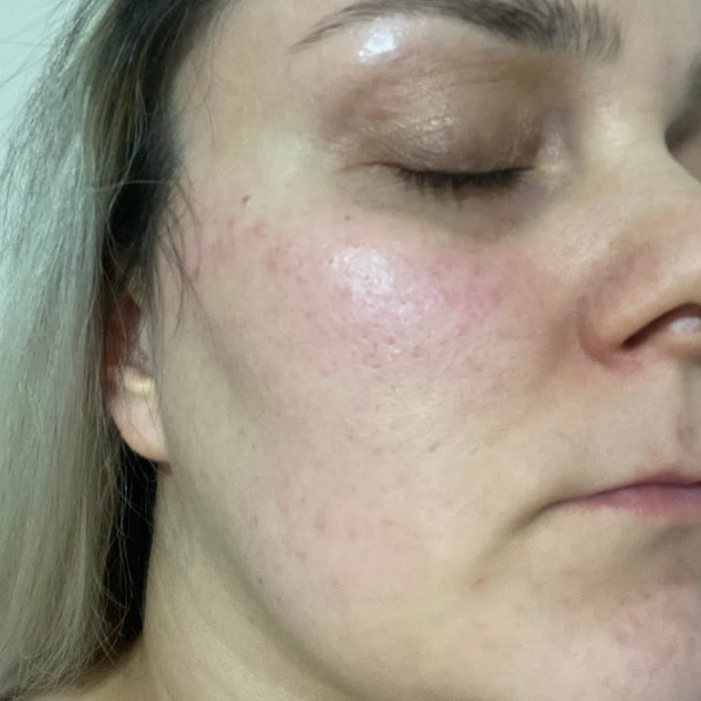 Trendyol Üzerinden Aldığım Bioderma Kreminde Cilt Reaksiyonu Ve İade Talebi