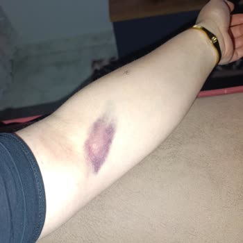 Göksun Devlet Hastanesi Kan Alımında Damar Patlaması Personelin Dikkatsizliği