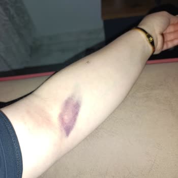 Göksun Devlet Hastanesi Kan Alımında Damar Patlaması Personelin Dikkatsizliği