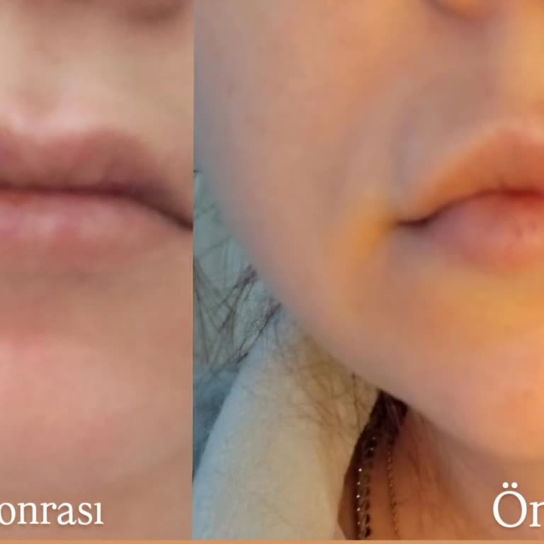 Uzman Estetisyen Gizem Yenice 3500 TL Karşılığında Faturasız Dudak Dolgusu Hiç Etki Görmedi