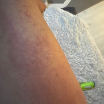 Veet Kremi Kullanımından Sonra Şiddetli Yanma Ve Çalışamaz Hale Gelme