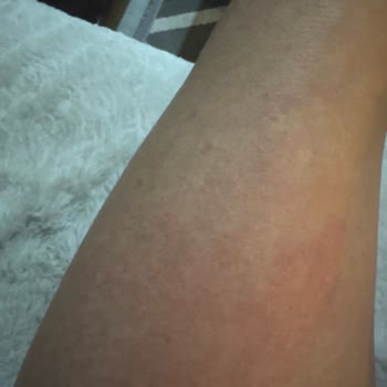 Veet Kremi Kullanımından Sonra Şiddetli Yanma Ve Çalışamaz Hale Gelme