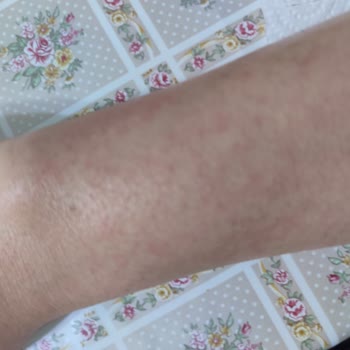 Afyon A101 Lure Tüy Dökücü Kremi Cilt Yanığı Ve Ücret İadesi Talebi