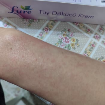 Afyon A101 Lure Tüy Dökücü Kremi Cilt Yanığı Ve Ücret İadesi Talebi