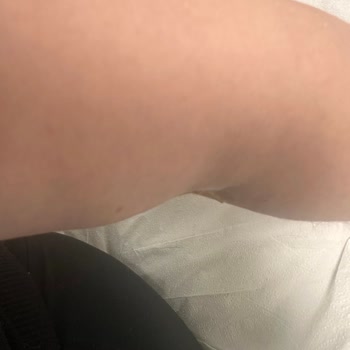 Medicana Sağlık Grubu Engelli Hastada Uzun Bekleme Ve Yanlış Damar Açma Sorunu