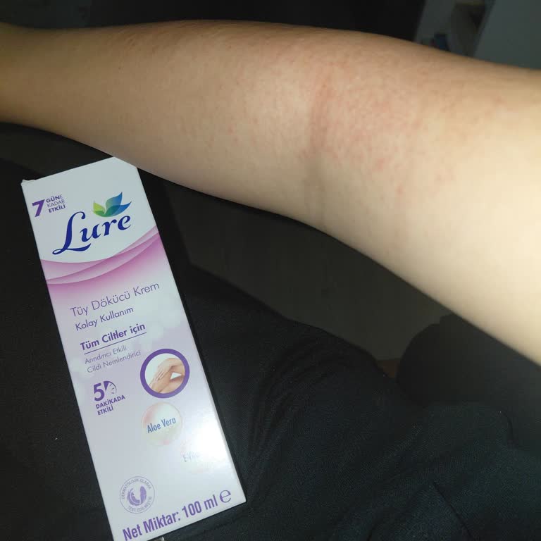 Lure Tüy Dökücü Kremde Şiddetli Yanma Ve Kızarıklık Yaşadım