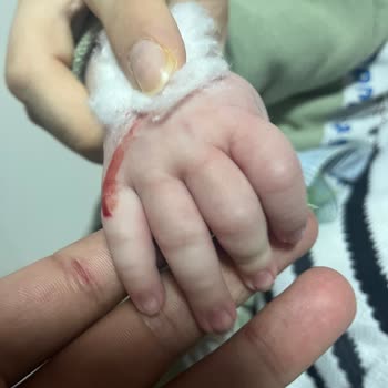 Damar Yolu Açmada İhmal Ve Yetersiz Mama Sebebiyle Bebekte Sağlık Riski