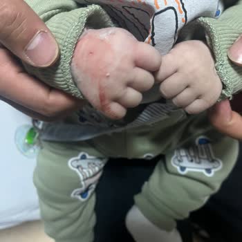 Damar Yolu Açmada İhmal Ve Yetersiz Mama Sebebiyle Bebekte Sağlık Riski