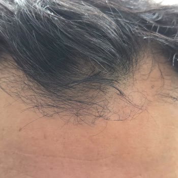 Erkan Özgün Saç Ekim Kliniği Hayal Kırıklığı Oldu!