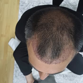 Erkan Özgün Saç Ekim Kliniği Hayal Kırıklığı Oldu!